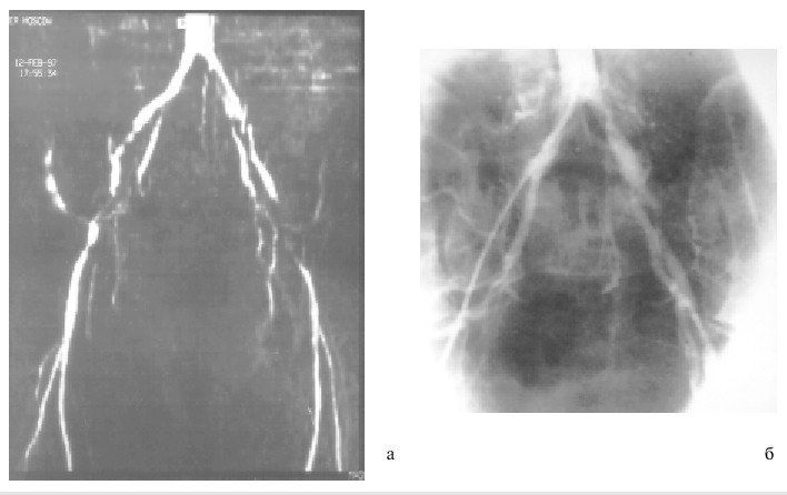 Хронические окклюзии артериальных сосудов фото